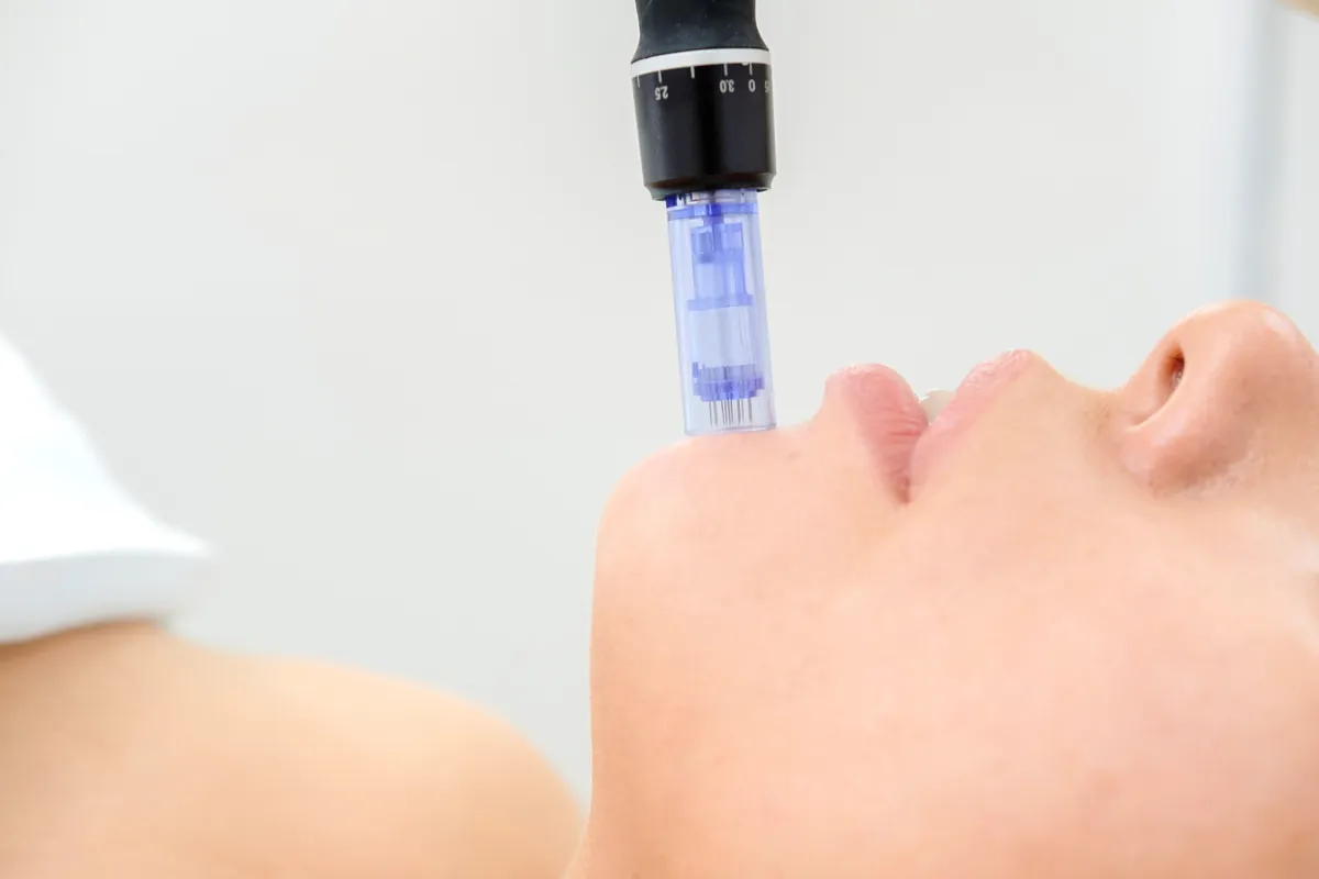Microneedling-Gerät SkinPen bei der Behandlung